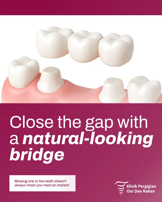 Close the gap with a natural bridge, treatment demand ad made by HPA for a Malaysian clinic